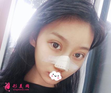 整形初体验:假体隆鼻后整理的隆鼻经验分享给大家【附图】