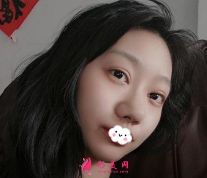 整形初体验:假体隆鼻后整理的隆鼻经验分享给大家【附图】