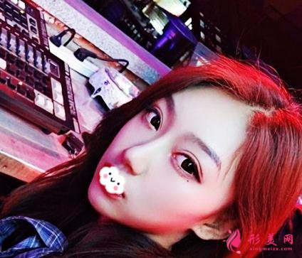 整形初体验:假体隆鼻后整理的隆鼻经验分享给大家【附图】