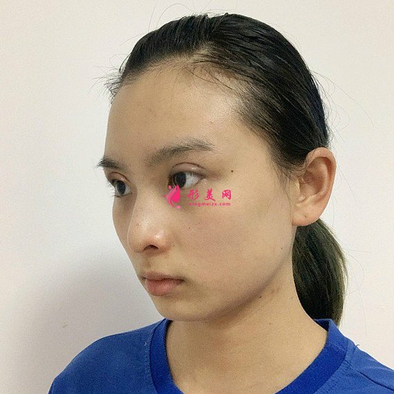 切开双眼皮 切开双眼皮