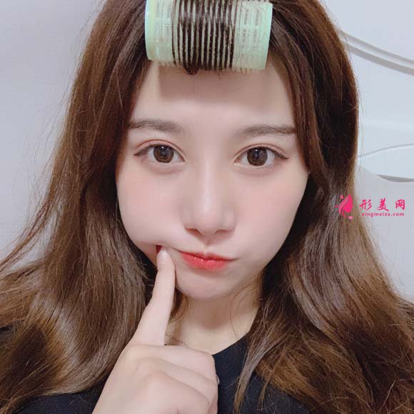 面部脂肪填充手术真实恢复过程,记录美好生活 面部脂肪填充手术真实恢复过程,记录美好生活