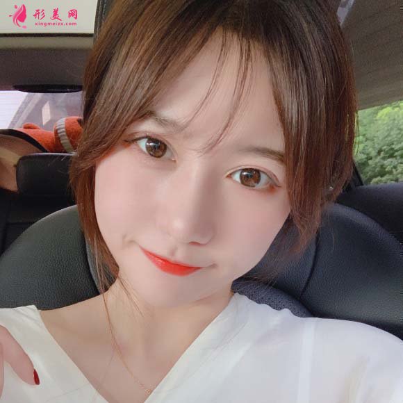 面部脂肪填充手术真实恢复过程,记录美好生活 面部脂肪填充手术真实恢复过程,记录美好生活