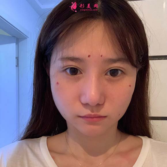 面部脂肪填充手术真实恢复过程,记录美好生活 面部脂肪填充手术真实恢复过程,记录美好生活