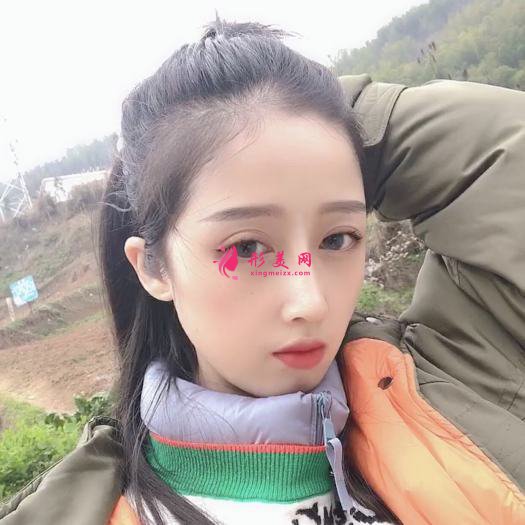 膨体隆鼻 膨体隆鼻