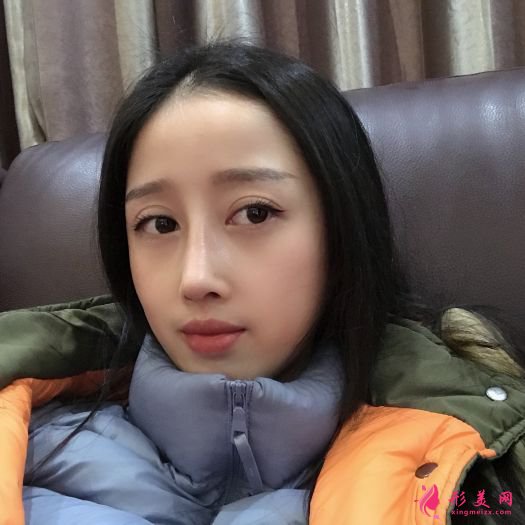 自体软骨隆鼻 自体软骨隆鼻