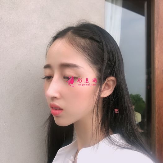 做完膨体隆鼻和自体软骨隆鼻后,鼻子挺了很多 做完膨体隆鼻和自体软骨隆鼻后,鼻子挺了很多