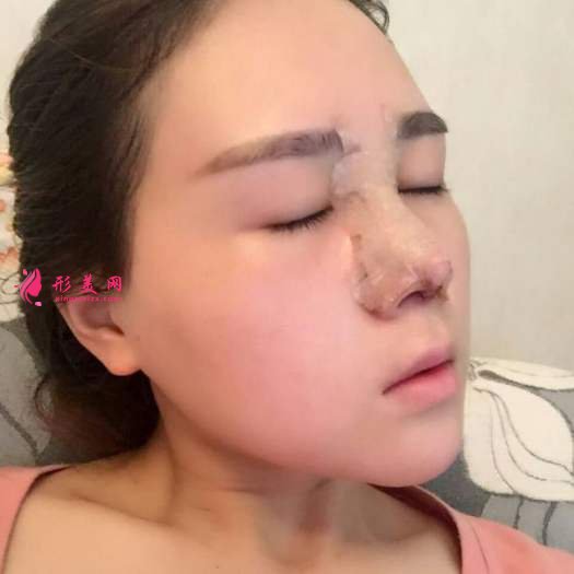 做自体肋软骨和膨体综合隆鼻后感受 做自体肋软骨和膨体综合隆鼻后感受