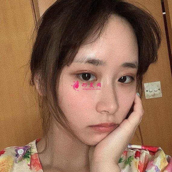 全切双眼皮恢复的速度很快,就算是素颜也很美! 全切双眼皮恢复的速度很快,就算是素颜也很美!