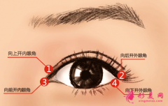 做开眼角后要多久恢复自然？