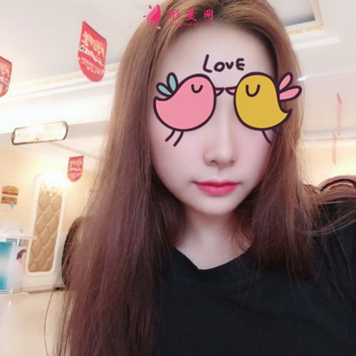 温州鼻部多项手术案例分享 温州鼻部多项手术案例分享