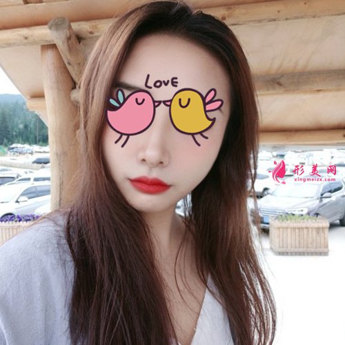 温州艺星隆鼻整形真实案例 温州艺星隆鼻整形真实案例