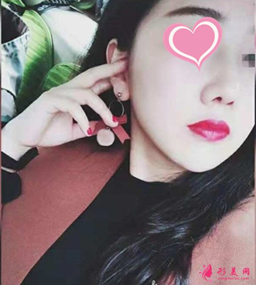 宁波郭光烨隆鼻多久能恢复 宁波郭光烨隆鼻多久能恢复