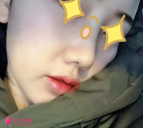 宁波壹加壹整形隆鼻真实案例 宁波壹加壹整形隆鼻真实案例