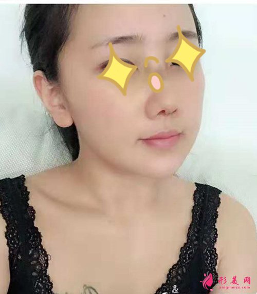 宁波假体隆鼻术后一周实拍 宁波假体隆鼻术后一周实拍