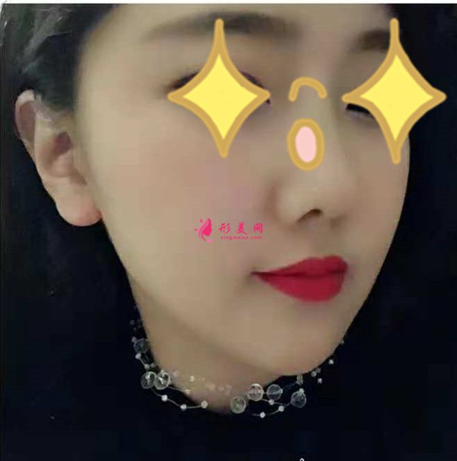 宁波郭光烨蒙特鼻效果好不好 宁波郭光烨蒙特鼻效果好不好