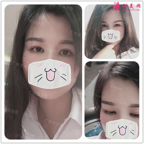 双眼皮开眼角术后三个月能恢复好吗 双眼皮开眼角术后三个月能恢复好吗