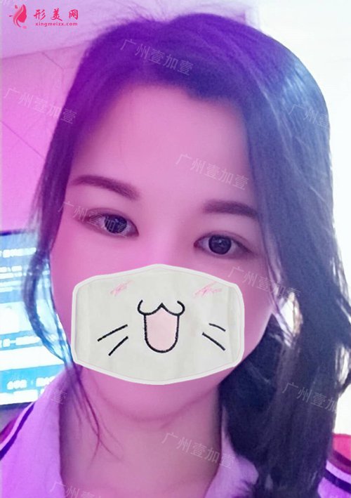 开眼角术后一个月 开眼角术后一个月