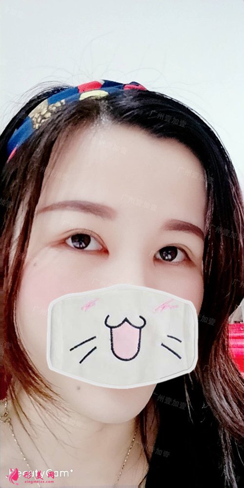 双眼皮开眼角术后40天 双眼皮开眼角术后40天