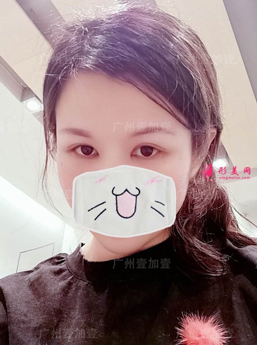 双眼皮术后15天 双眼皮术后15天