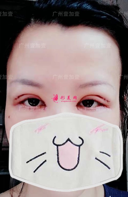 双眼皮术后第二天 双眼皮术后第二天