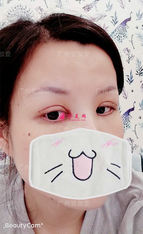 双眼皮开眼角术后一周 双眼皮开眼角术后一周