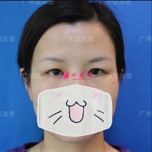 广州壹加壹整形医院眼整形案例 广州壹加壹整形医院眼整形案例