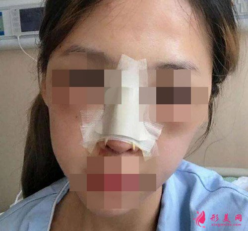 鼻综合手术术后即刻效果 鼻综合手术术后即刻效果