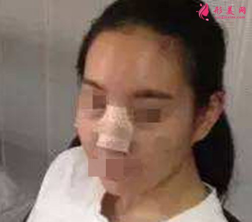 鼻综合手术术后第4天效果 鼻综合手术术后第4天效果