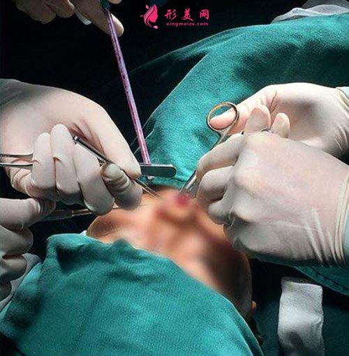 鼻综合手术正在进行 鼻综合手术正在进行