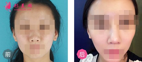 鼻综合手术的术前和术后的对比案例图 鼻综合手术的术前和术后的对比案例图