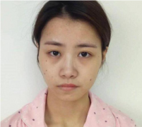 南京华美翟奔宇隆鼻术后恢复效果图分享