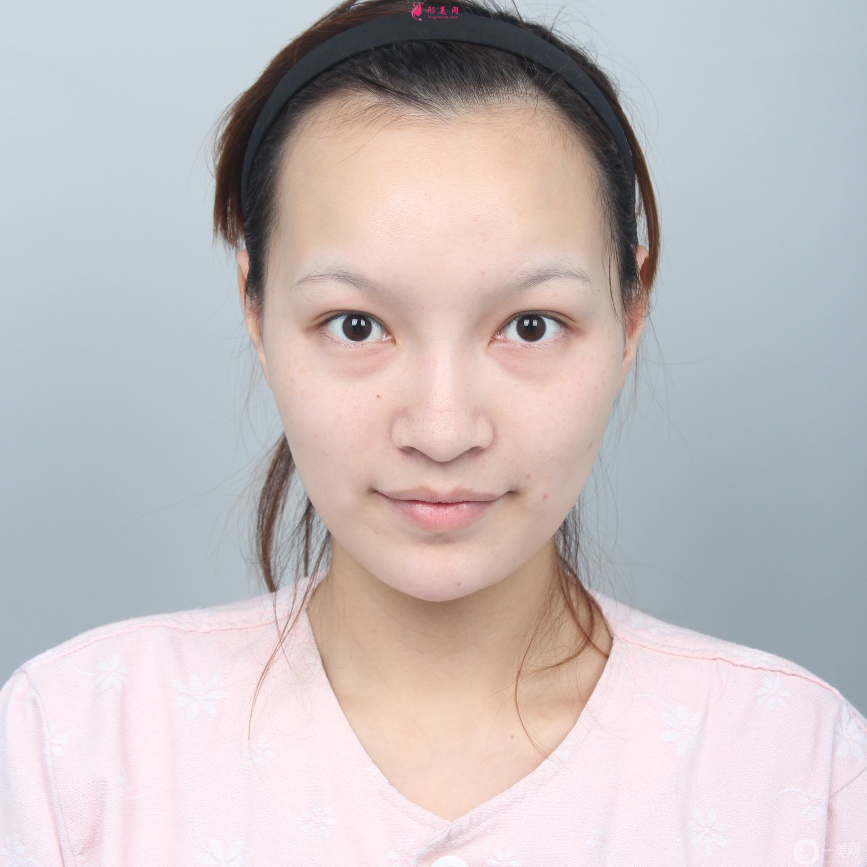 上海美联臣下颌角整形恢复日记分享:术后500天了依然很完美~