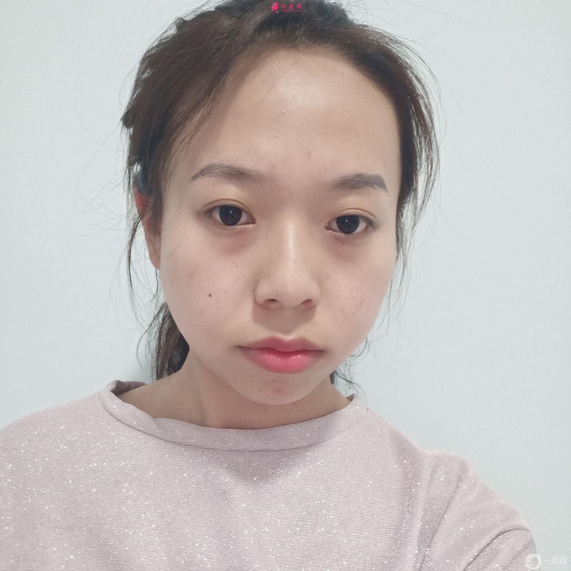 自体脂肪面部填充才一个月就让我找回了自信!