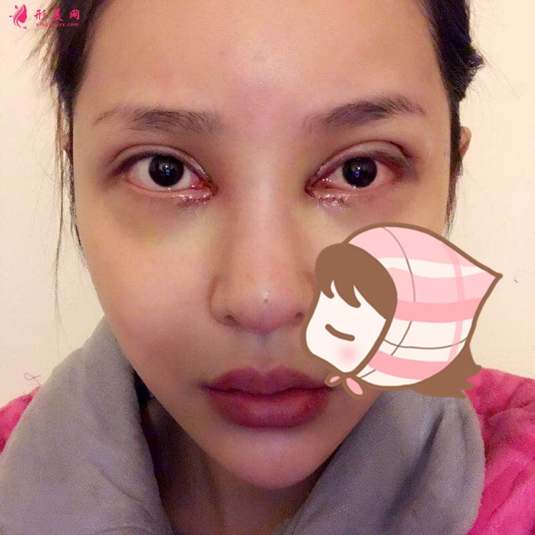 杭州瑞丽整形医院韩德昌医生眼综合案例