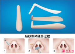 假体隆鼻术后还要更换吗？