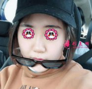 浙医二院整形科隆鼻术后真实效果图分享