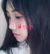 南昌二附院整形美容科割双眼皮怎么样？效果对比图曝光