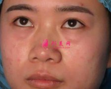 重庆艺星整形祛眼袋怎么样?术后效果分享