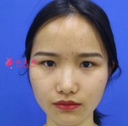 厦门安黛美整形美容双眼皮怎么样？术后三个月对比看效果