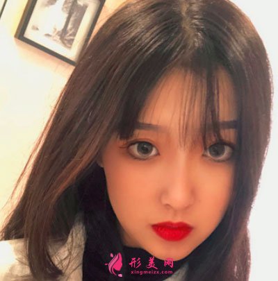 宁波静港整形自体脂肪面部填充案例