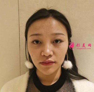 昆明艺星医疗美容医院鼻部多项案例