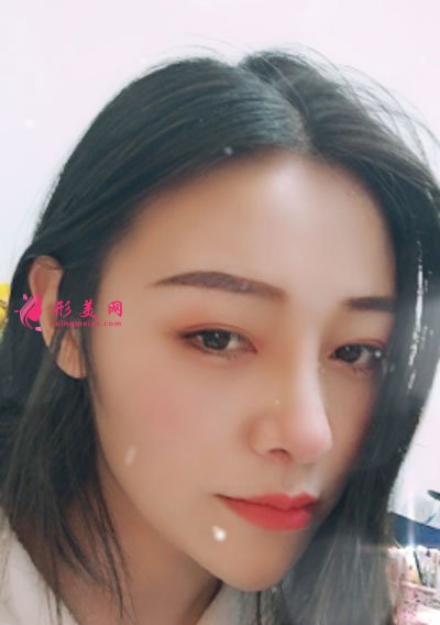 昆明艺星医疗美容医院鼻部多项案例