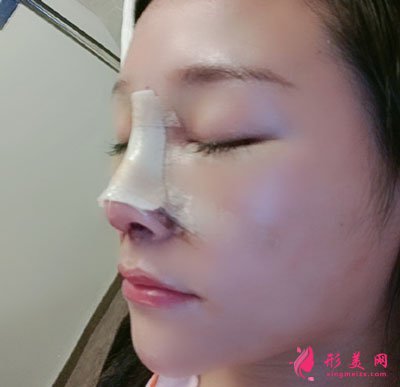 昆明艺星医疗美容医院鼻部多项案例