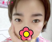 湖南省人民医院整形科做双眼皮咋样?术后经验效果一览