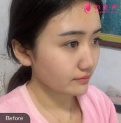 上海九院余东颧骨整形案例术后恢复日记，V脸来啦！