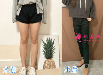 宁波静港整形美容祝海新案例 宁波静港整形美容祝海新案例