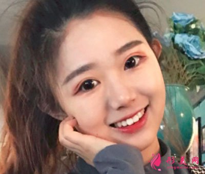 厦门华美于璇切开双眼皮案例 厦门华美于璇切开双眼皮案例