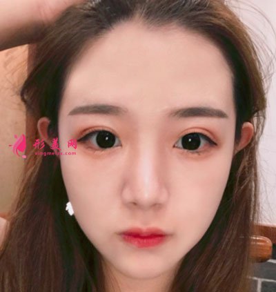 厦门华美于璇切开双眼皮案例 厦门华美于璇切开双眼皮案例