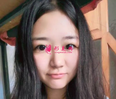 厦门华美于璇切开双眼皮案例 厦门华美于璇切开双眼皮案例