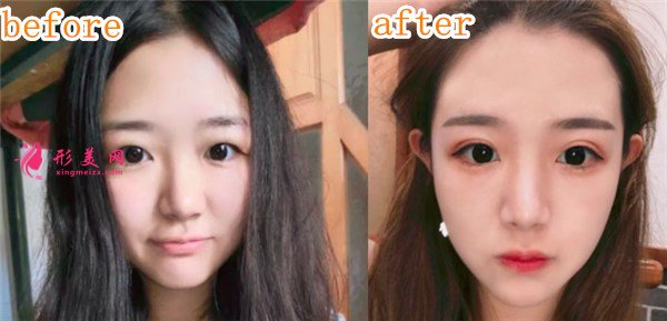 厦门华美于璇切开双眼皮案例 厦门华美于璇切开双眼皮案例